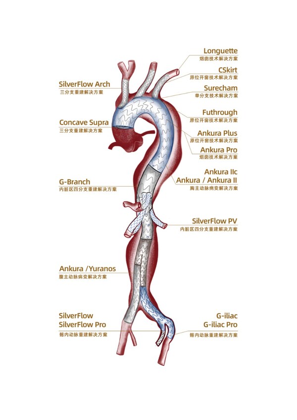 （图：先健主动脉微创治疗整体解决方案）